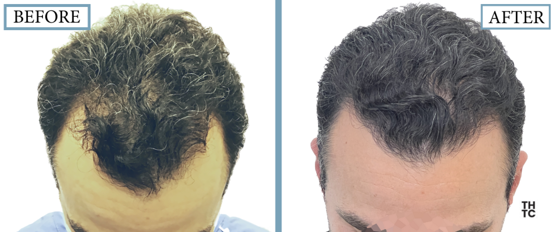 Hair Transplant Toronto